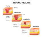 The Healing Process to Bleeding - First Aid Wiki