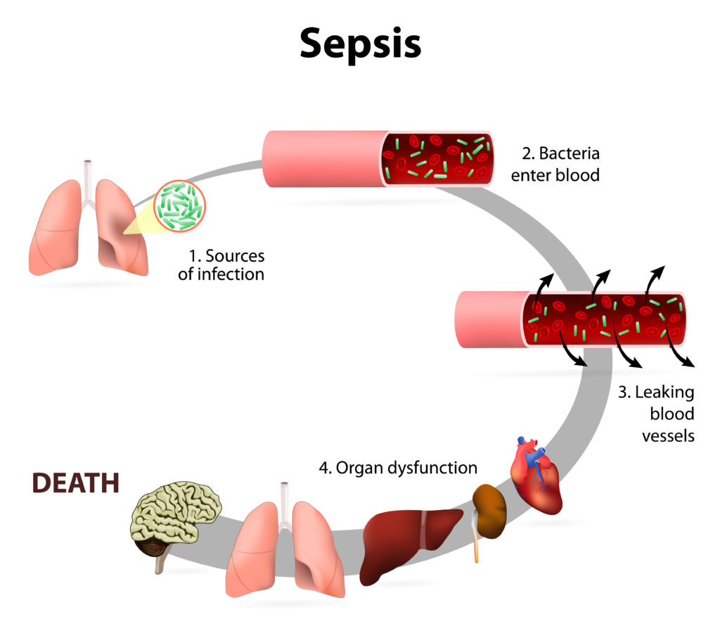 sepsis-first-aid-wiki