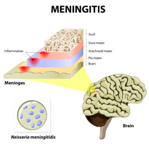 Meningitis