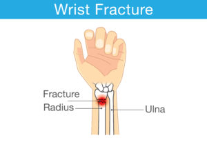 fractured wrist