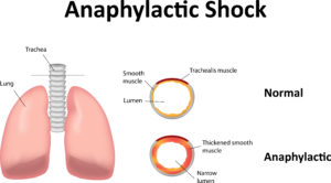 Anaphylaxis