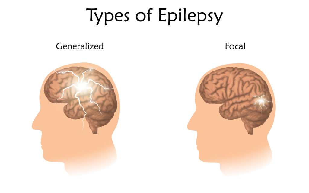 Epilepsy - First Aid Wiki