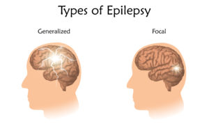 Epilepsy