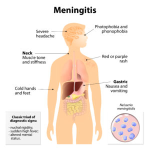 Meningitis