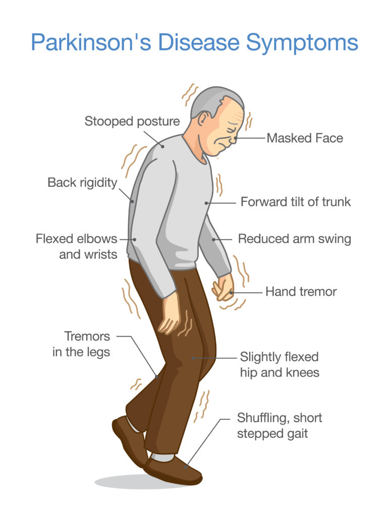 Parkinson s Disease Information On This Disease And The Treatment